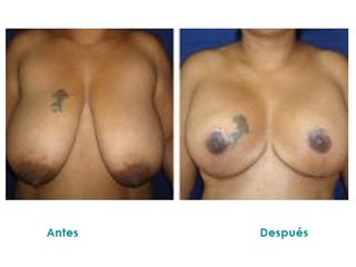 Mastopexia