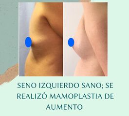 Mamoplastia de aumento - Dra. Andrea Halliday Rueda