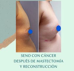 Reconstrucción mamaria - Dra. Andrea Halliday Rueda
