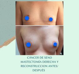Reconstrucción mamaria - Dra. Andrea Halliday Rueda
