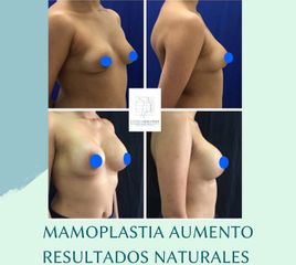 Mamoplastia de aumento - Dra. Andrea Halliday Rueda