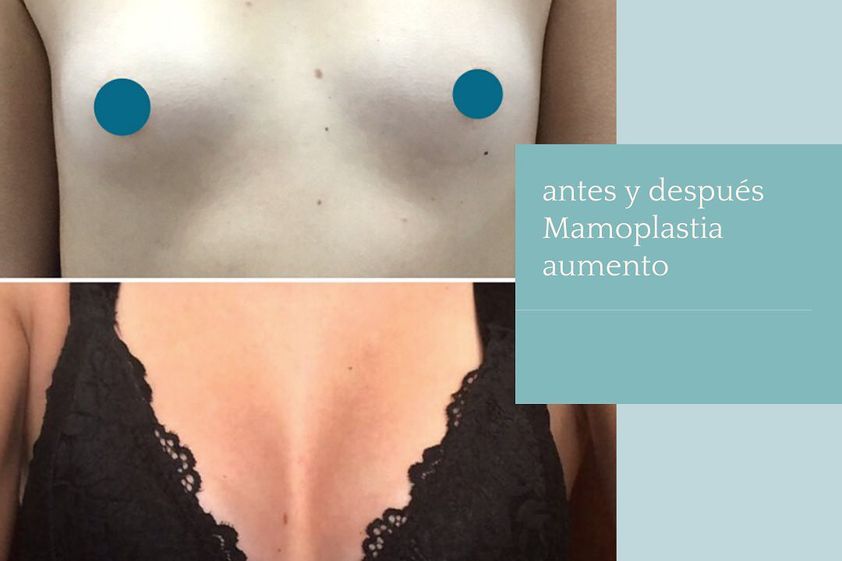 Mamoplastia de aumento antes y después - 852964
