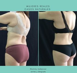 Lipoescultura - Dra. Andrea Halliday Rueda
