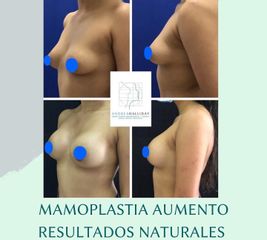 Mamoplastia de aumento - Dra. Andrea Halliday Rueda