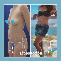 Liposucción - Dra. Andrea Halliday Rueda