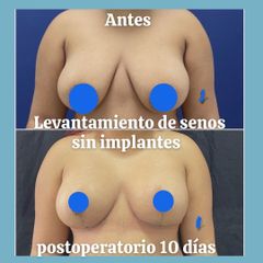 Levantamiento de senos - Dra. Andrea Halliday Rueda