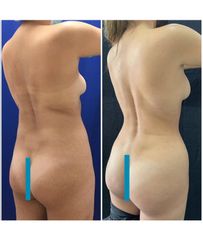 Liposucción - Dra. Andrea Halliday Rueda