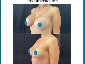Reconstrucción mamaria antes y después - 852979