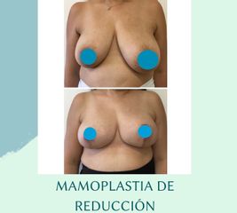 Mamoplastia de reducción - Dra. Andrea Halliday Rueda