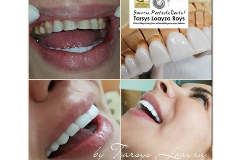 Diseño de sonrisa antes y después - 613678