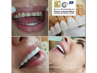 1 Sonrisa Perfecta Dental - Dra. Tarsys Loayza Roys 