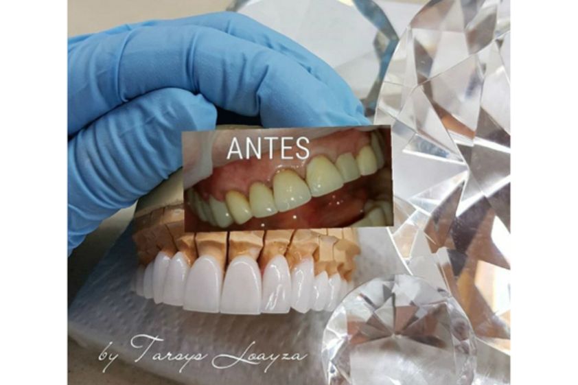 Diseño de sonrisa antes y después - 613682