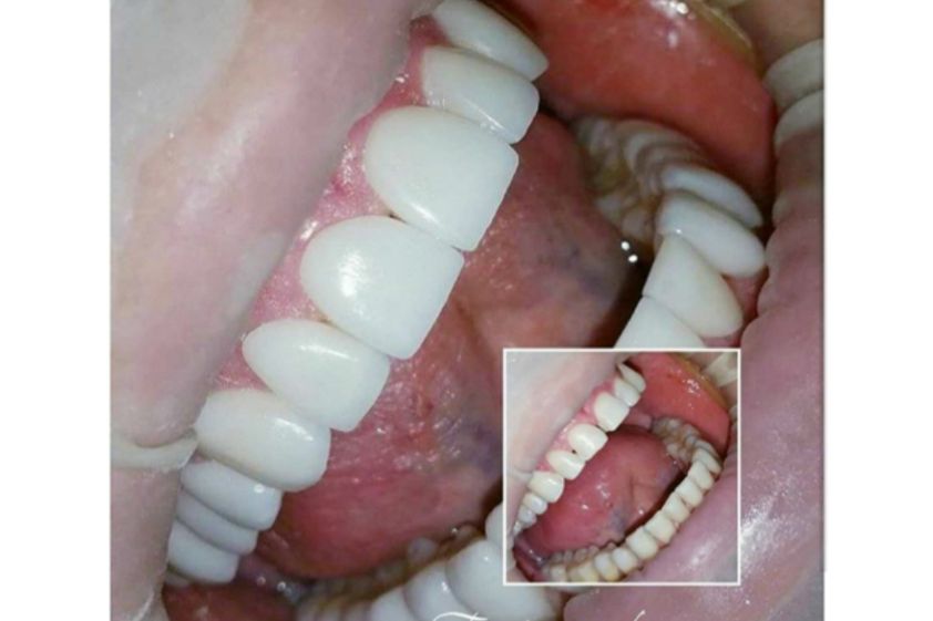 Diseño de sonrisa antes y después - 613686