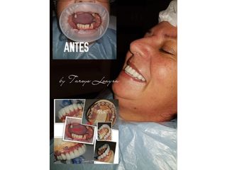 Implantes dentales - Dra. Tarsys Loayza Roys