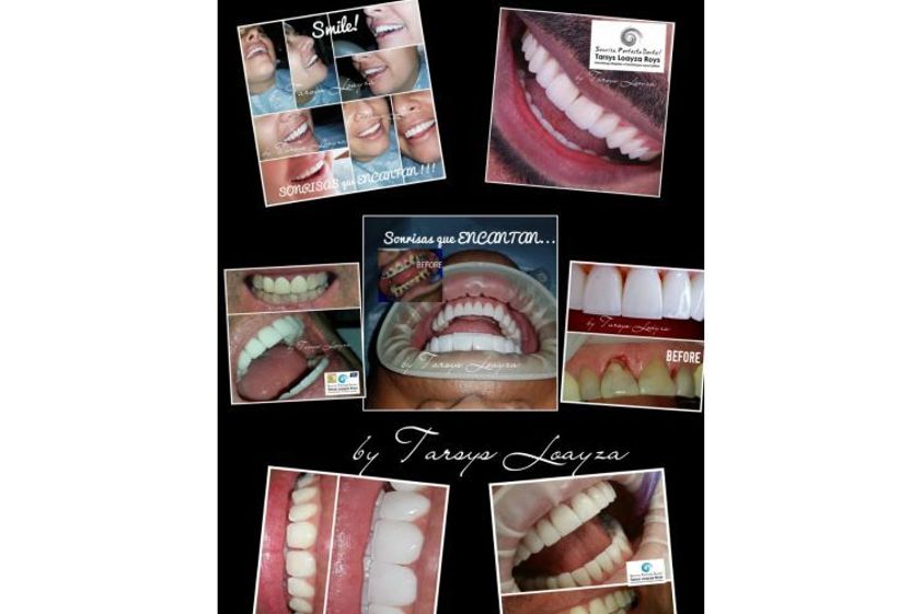 Implantes dentales antes y después - 693518