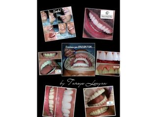 Implantes dentales - Dra. Tarsys Loayza Roys