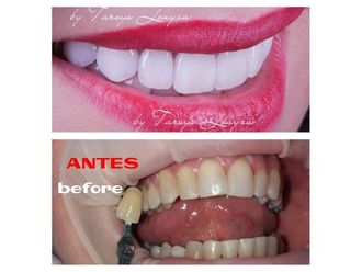 Blanqueamiento dental - 693519