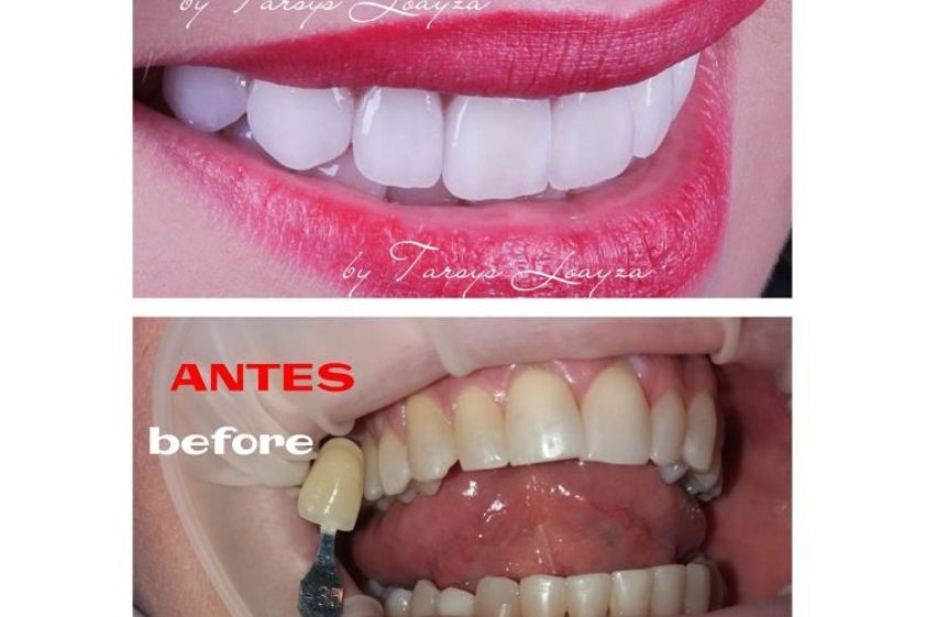 Blanqueamiento dental antes y después - 693519