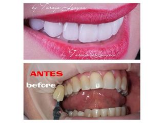 Blanqueamiento dental - Dra. Tarsys Loayza Roys