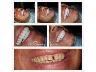 Implantes dentales - Dra. Tarsys Loayza Roys