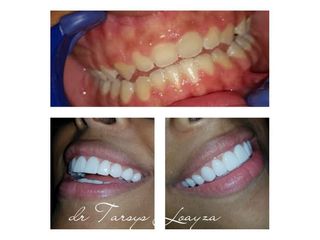 Implantes dentales - Dra. Tarsys Loayza Roys