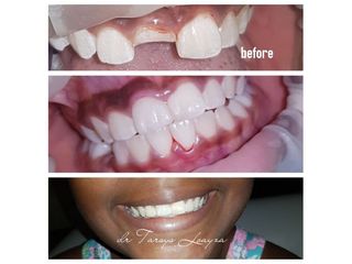 Implantes dentales - Dra. Tarsys Loayza Roys