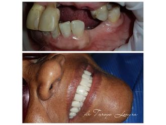 Implantes dentales - 693530