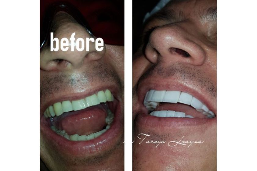 Blanqueamiento dental antes y después - 693533