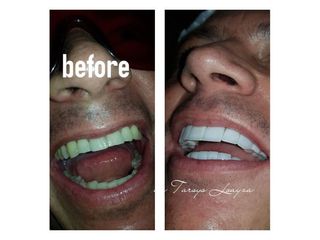 Blanqueamiento dental - Dra. Tarsys Loayza Roys