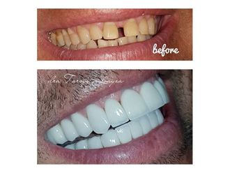 Implantes dentales - 693535