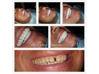 Implantes dentales - 693537