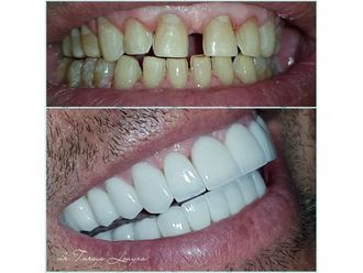 Implantes dentales - 693538