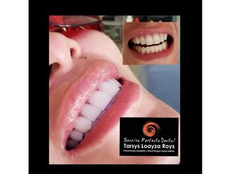 Implantes dentales - 693539