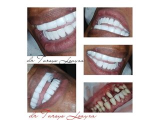 Implantes dentales - Dra. Tarsys Loayza Roys