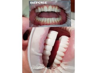 Implantes dentales - 693543