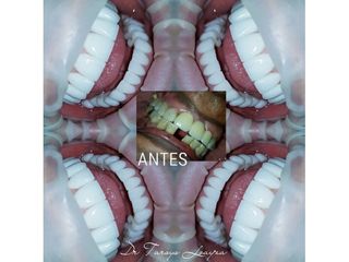 Implantes dentales - Dra. Tarsys Loayza Roys