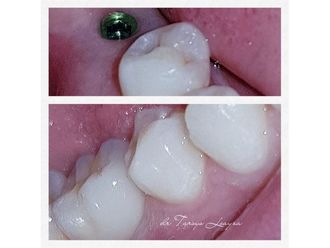 Implantes dentales - 693554
