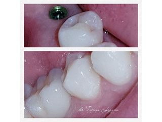 Implantes dentales - Dra. Tarsys Loayza Roys