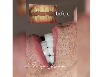 Blanqueamiento dental - 693558