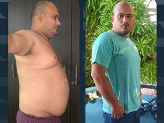 Balón Gástrico antes y después - 812300