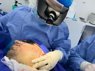 Implante de Barba Técnica FUE - Idéaliste