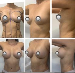 Mamoplastia de aumento - Idéaliste