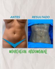 Marcación Abdominal - Idéaliste