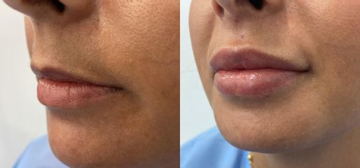 Aumento de labios - Médica Vivir