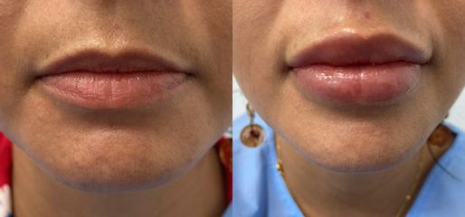Aumento de labios - Médica Vivir