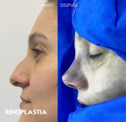 Rinoplastia - Idéaliste