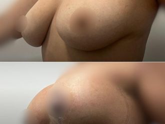 Reconstrucción mamaria antes y después - 873082