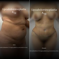 LIPOABDOMINOPLASTIA -  Idéaliste