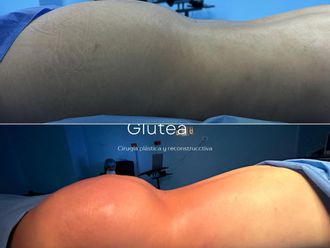 Gluteoplastia antes y después - 873182