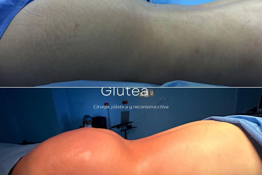 Gluteoplastia antes y después - 873182